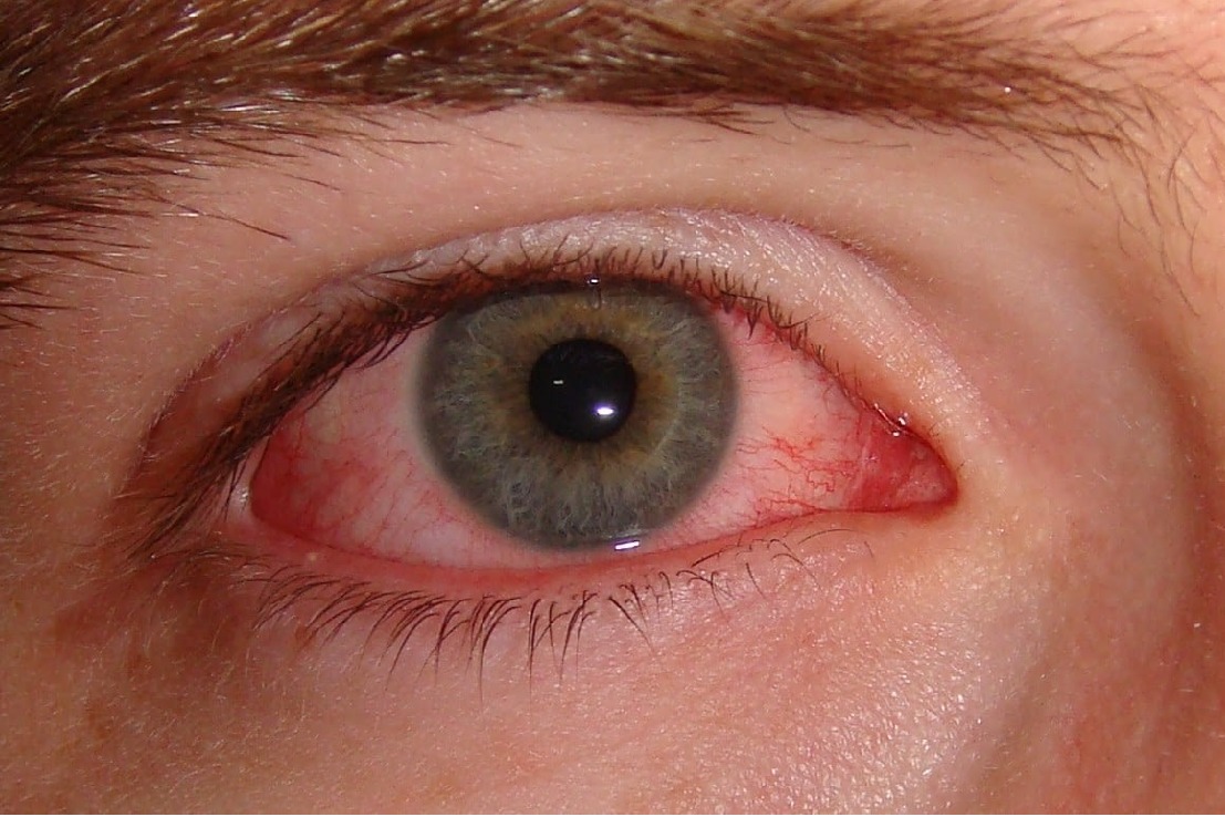 Eye strain may be a symptom of Corona 
