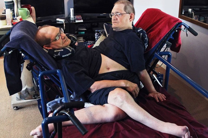 Ronnie and Donnie Galyon Worlds Longest Surviving Conjoined Twin Brothers Died