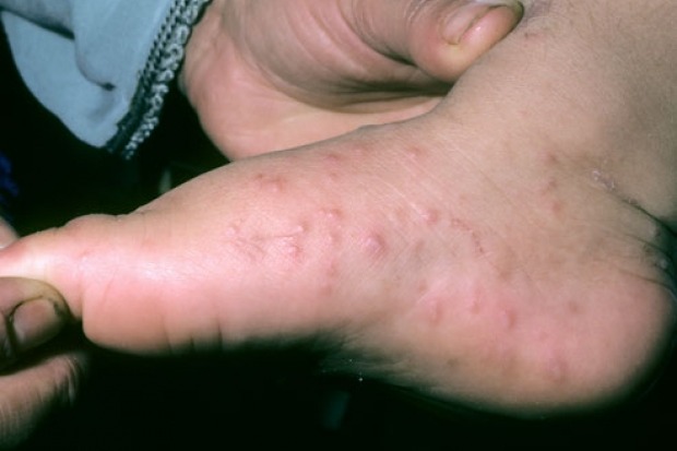 Rashes on feet could be sign of Covid19