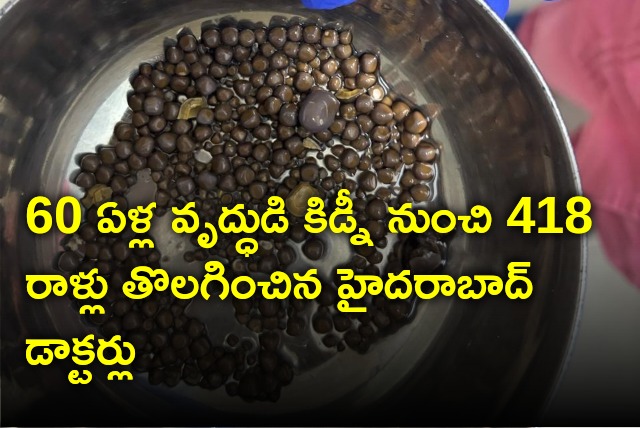 AINU Hyderabad doctors removes 418 stones from kidney
