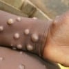 CDC and Texas Confirm Monkeypox In US