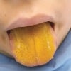Boy Tongue Changed To Yellow Suffered Auto Immune Disorder