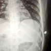 Man thought a cat scratched him but in reality a bullet lodged in his ribs