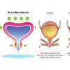 Urinary Incontinence