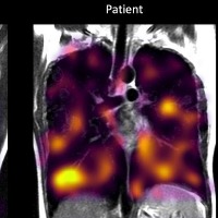 Lungs In Long Covid Patients Suffering Damage