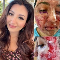 Indian-American Miss World 2021 first runner-up lives with pacemaker, survived facial burns