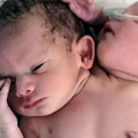 Baby born with two heads and three hands in MPs Ratlam