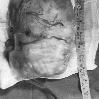 Doctors at SLG Hospitals remove a 3 kgs giant fibroid from a woman
