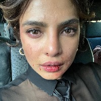 Priyanka Chopra shares picture of 'bruised' face from 'Citadel' set