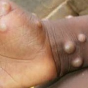 US sees first monkeypox case of 2022 as Europe reports small outbreaks