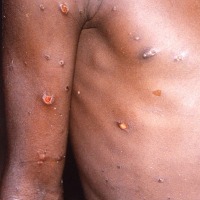 Suspected Monkey Pox Case In India