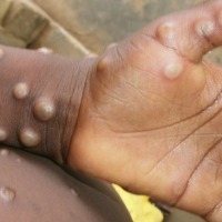 High skin lesions, low fever new symptoms of monkeypox: Lancet