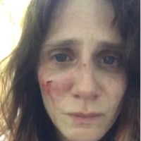 Victim of domestic abuse, French actress posts shocking pics on Instagram