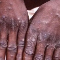 US at risk of losing control of monkeypox outbreak