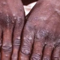 Suspected case of monkeypox in Kerala, sample sent for testing