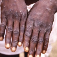 Monkeypox symptoms reported in traveller from UAE 