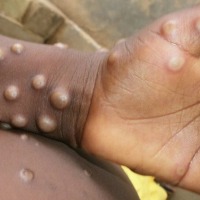 Rectal pain, penile swelling more common in current monkeypox outbreak