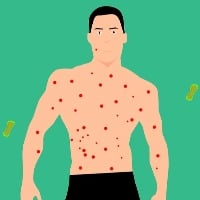 Monkeypox vs chickenpox key differences according to doctors