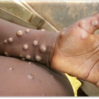 Clinical trial of Tecovirimat drug to treat monkeypox begins at Oxford