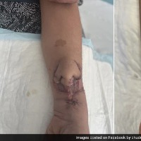 Surgeons In France Successfully Transplant Nose Grown On Womans Arm To Her Face