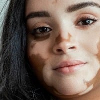 What is vitiligo The skin condition Malayalam actress Mamta is diagnosed with