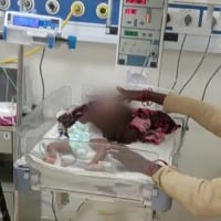 3 Month Old Baby Poked 51 Times With Hot Rod To Treat Pneumonia