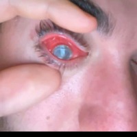 Man lost his eye due to parasites formed under contact lenses 
