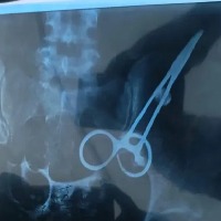 Doctor leaves scissors in Telangana womans stomach after surgery