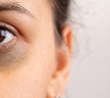 From lifestyle to genetics What really causes dark circles and how to fix them