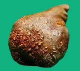 Sri Lankan Doctors Removed World Largest Kidney Stone