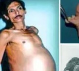 Nagpur Man pregnant with his twin inside him for 36 years
