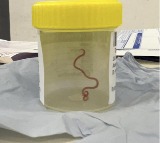 Doctors remove 3 inch parasitic worm from womans brain in world first
