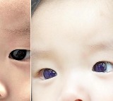 Babys Dark Brown Eyes Turn Blue After Covid 19 Treatment In Thailand
