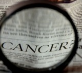 AI twice as accurate as biopsy at diagnosing severity of rare cancer: Study