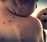 Measles cases rising alarmingly across Europe: WHO