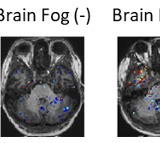 Leaky blood vessels behind Long Covid-linked brain fog, says study