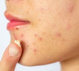 Doctors Recommend Chilling Acne Creams Before Use To Reduce Cancer Risk