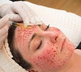 At Least 3 Women Contracted HIV After Getting Vampire Facial At Spa 