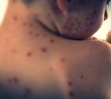 Global measles cases see 88pc jump in 2023 from 2022: WHO