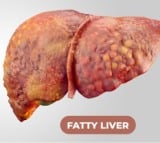 fatty liver disease cases up in hyderabad after work from home