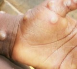 Monkeypox case detected in South Africa