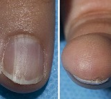 How your nail colour can signal cancer risk