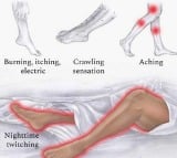 Scientists find treatment for restless leg syndrome