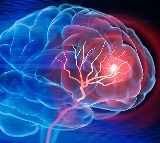 Delhi-NCR doctors treat life-threatening brain aneurysm condition with novel technique