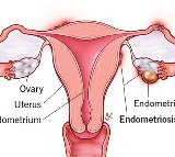 Swiss researchers develop a hydrogel implant to treat endometriosis