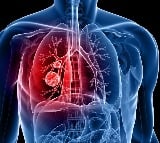 Lung cancer is most common cancer to spread to brain: Experts