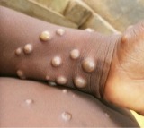 China tightens precautions at ports as global mpox cases increase