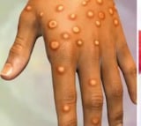 Monkeypox virus reaches to Pakistan