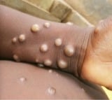 Mpox impacting a broader demographic, warns Lancet report