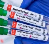 Monkeypox kills 610 in Congo: Health Minister